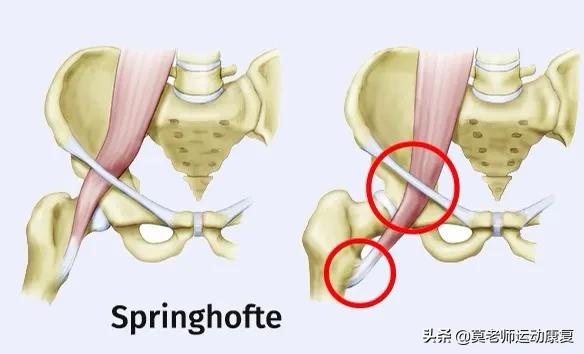 走路时髋关节内侧弹响怎么锻炼,运动时髋关节内侧响疼