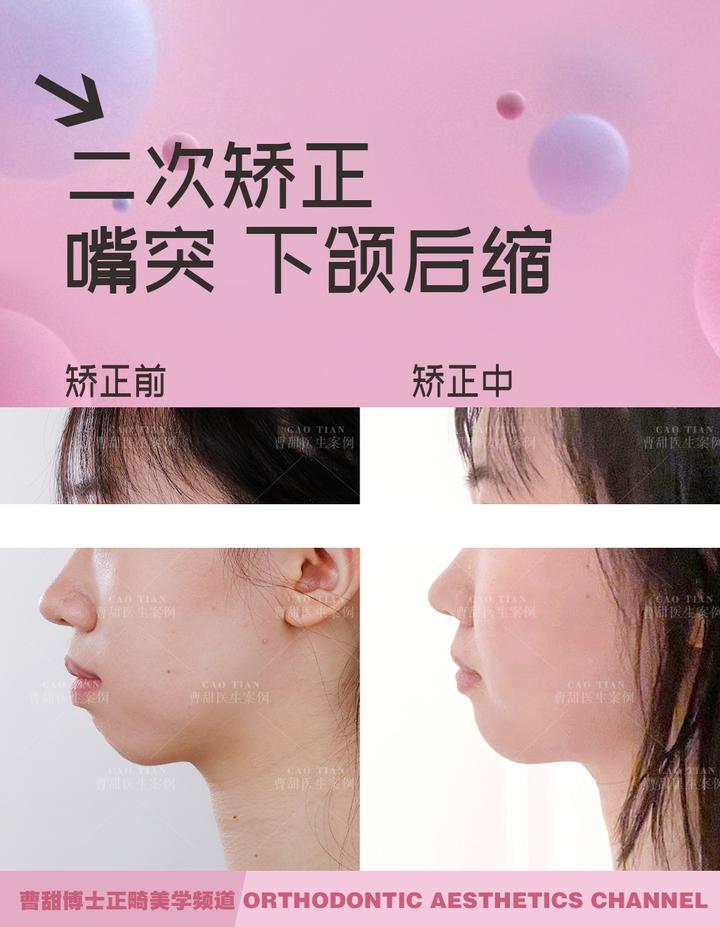 不拔牙矫正嘴凸下巴后缩案例,嘴瘪不拔牙矫正嘴会凸怎么办