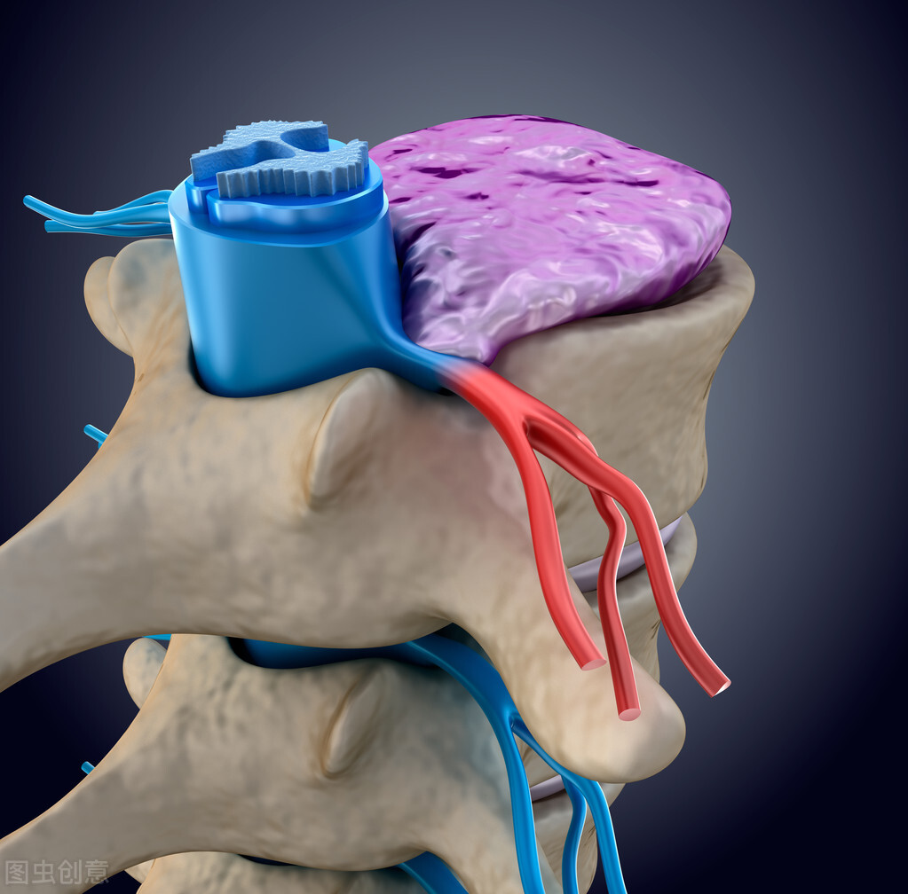 腰突引起大髋关节疼如何治疗,腰痛有哪些微创介入治疗方法