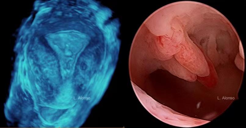 患上子宫内膜息肉怎么办？是等它自行消退？还是手术切除？