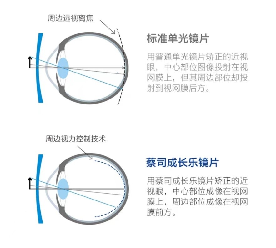 当孩子发生近视家长更需擦亮双眼,近视会影响孩子的前途吗