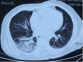 免疫缺陷病会并发什么病,什么是免疫缺陷肺部感染