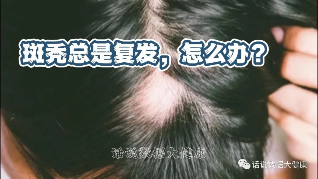 首个获批治疗严重脱发的药物，服用后就像脱发从未发生一样？