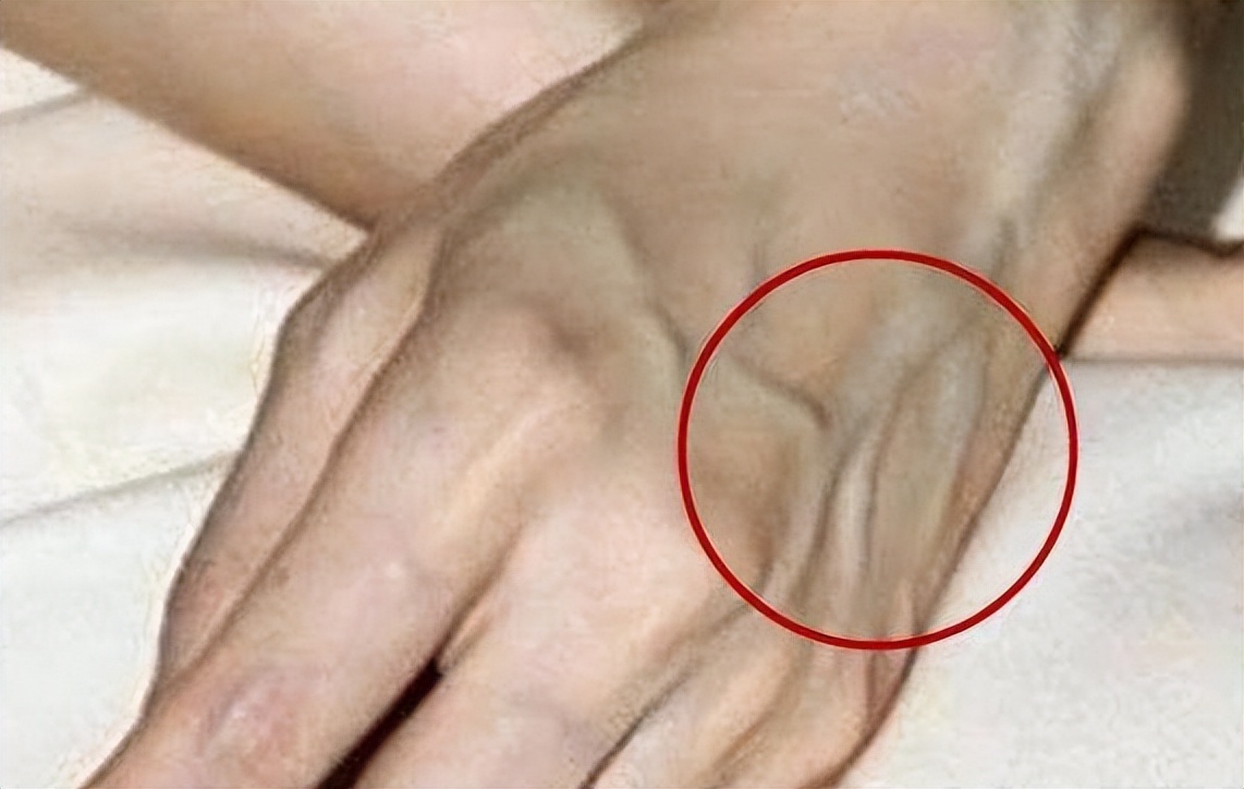 胳膊青筋手背青筋多是怎么回事,人体青筋明显是什么问题