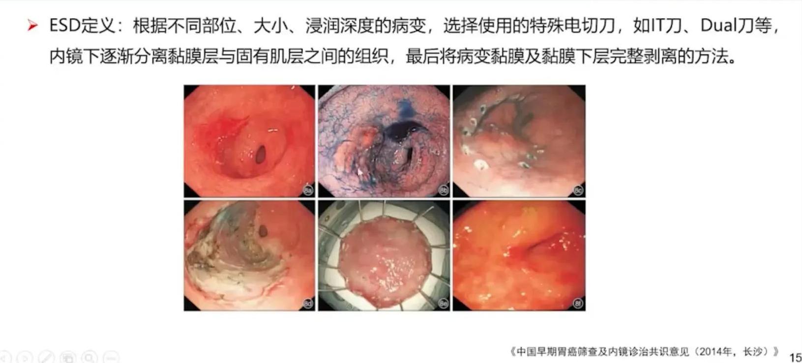 胃早癌食管早癌会复发吗,胃早癌与进展期癌怎么区分