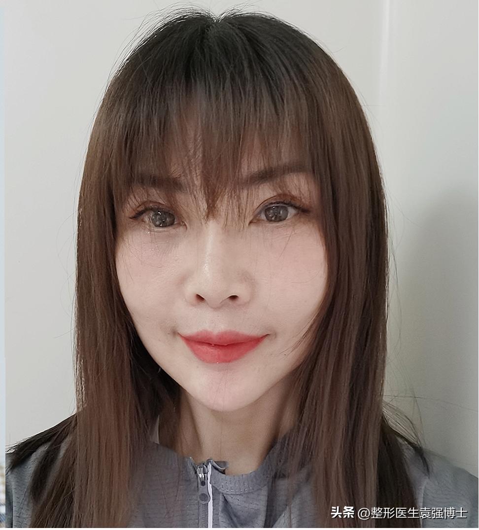 北京做大拉皮前后对比照片图文,面部做大拉皮提升的真实案例