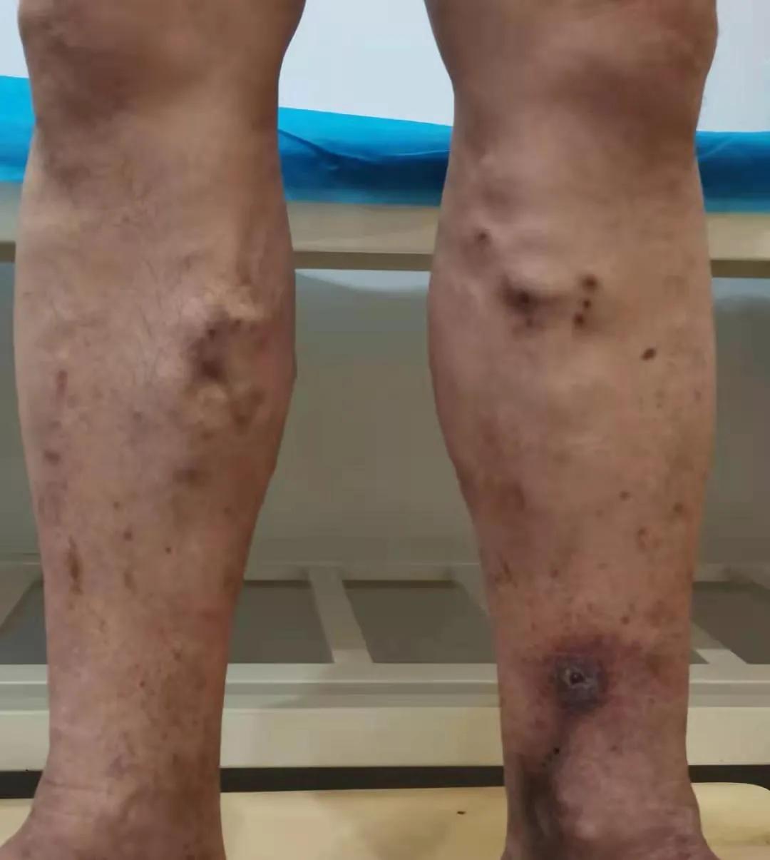 臭氧治疗静脉曲张好不好,臭氧疗法治疗静脉曲张效果怎么样