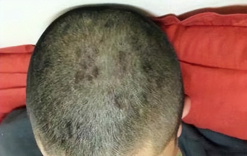 男士头上长疙瘩脓包,头上起疙瘩有脓包还掉发什么原因