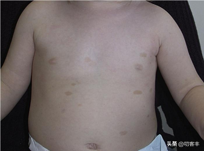婴儿的咖啡牛奶斑怎么治疗,宝宝的咖啡牛奶斑图片