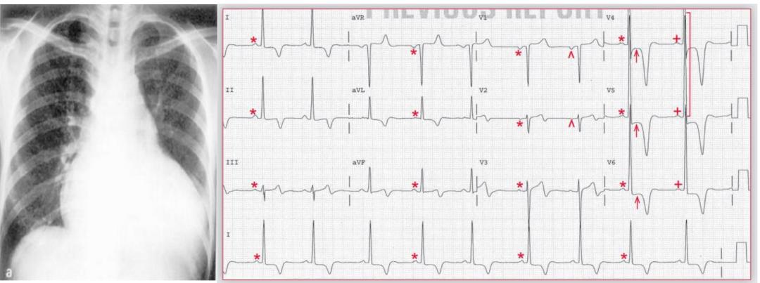 心电图qrs间期变长是怎样造成的,心电图qrs振幅多少是正常范围