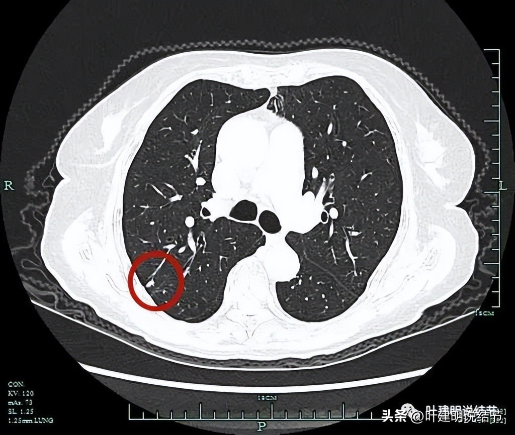79岁肺癌早期手术风险,75岁早期浸润性肺癌还要治疗吗