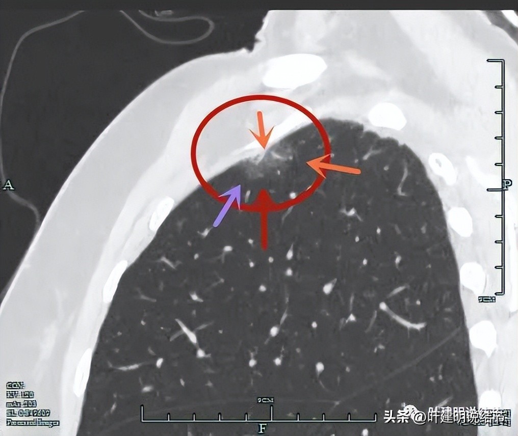 肺癌病理的肿块是硬的吗,肺癌病灶什么样