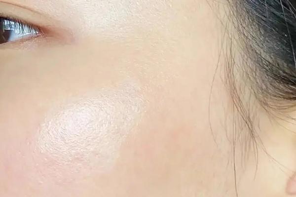 皮肤出油爱长痘怎么解决,皮肤出油长痘暗沉毛孔粗大有粉刺