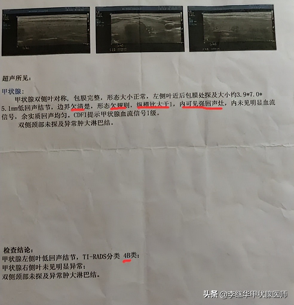一旦发现有甲状腺结节就要手术吗,请问医生甲状腺结节是不是亚甲炎