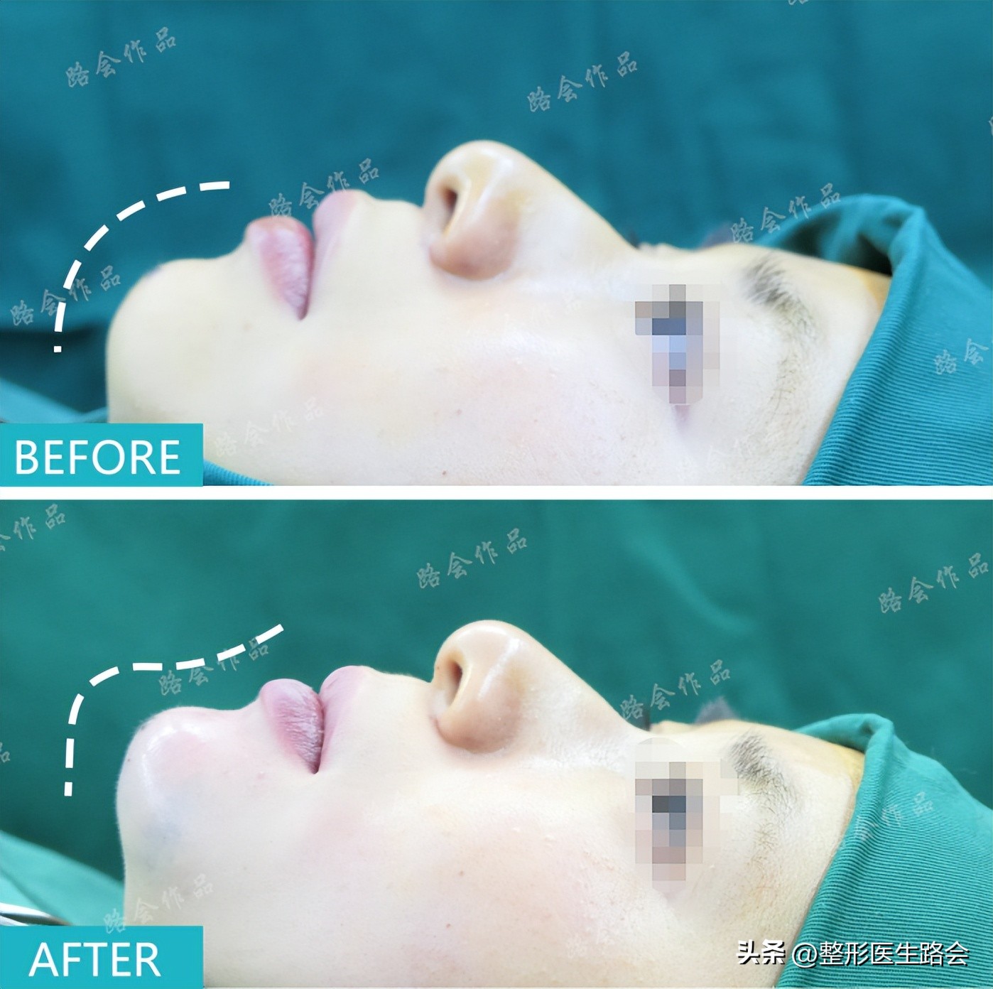 做假体下巴后的真实感受,做了假体下巴很后悔