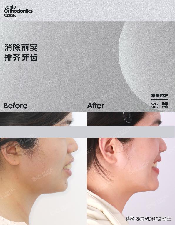 闭嘴巴下巴有核桃纹做什么手术,为什么下巴会有像核桃一样的纹路