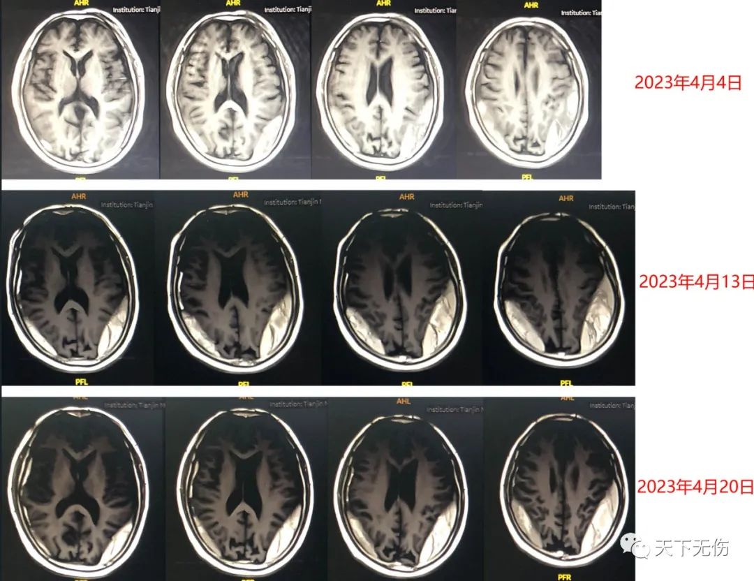 慢性硬膜下血肿的科普视频,右侧慢性硬膜下血肿是什么意思