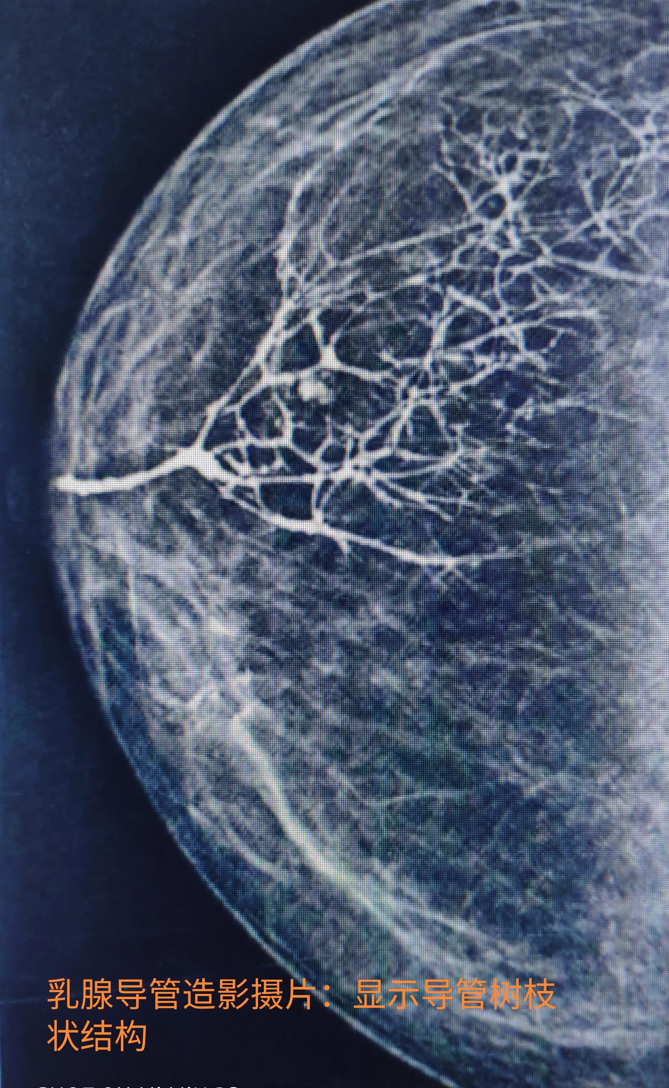 除了乳腺癌胸部还可能会得什么病,乳腺导管内病变不除外4a严重吗