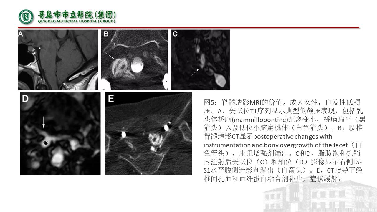 低颅压综合征耳闷,低颅压综合征吃什么药