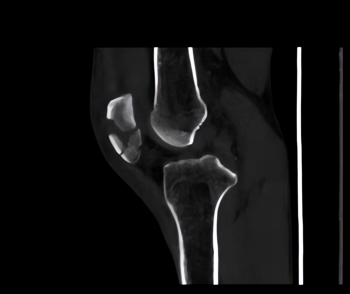 髌骨轻微骨折四年了应该怎么治疗,男性48岁髌骨骨折要多久才能恢复