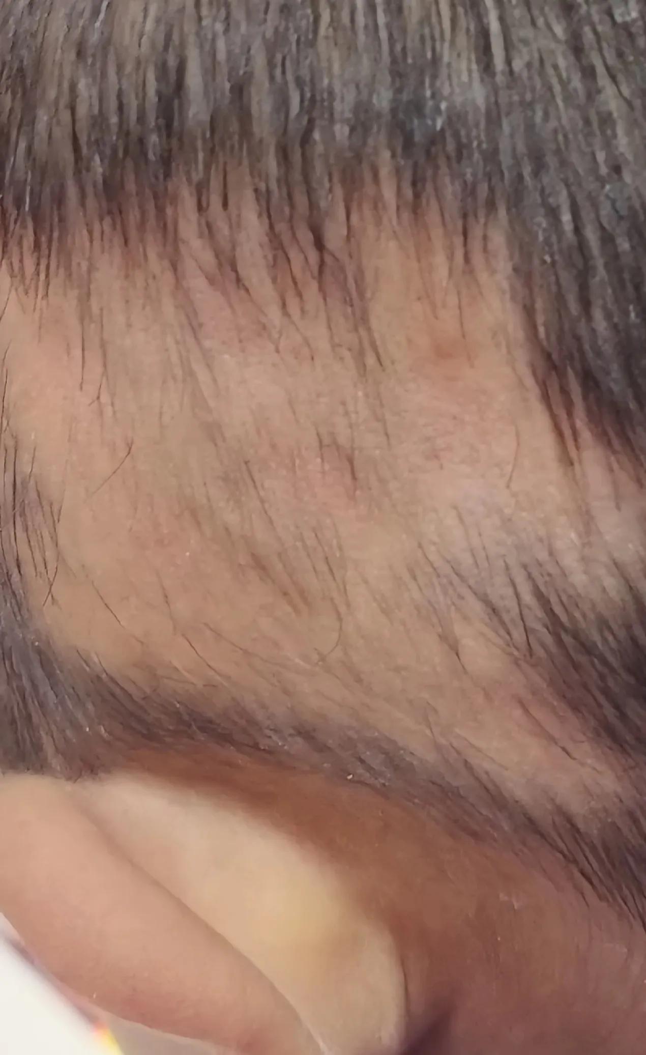 小孩斑秃掉头发厉害,儿童斑秃一个月全掉完了