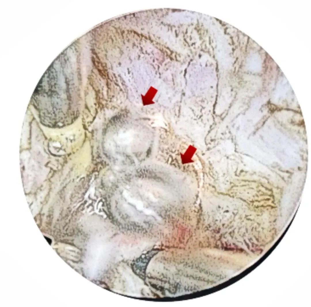 宫腔镜摘除子宫肌瘤,微创宫腔镜子宫肌瘤