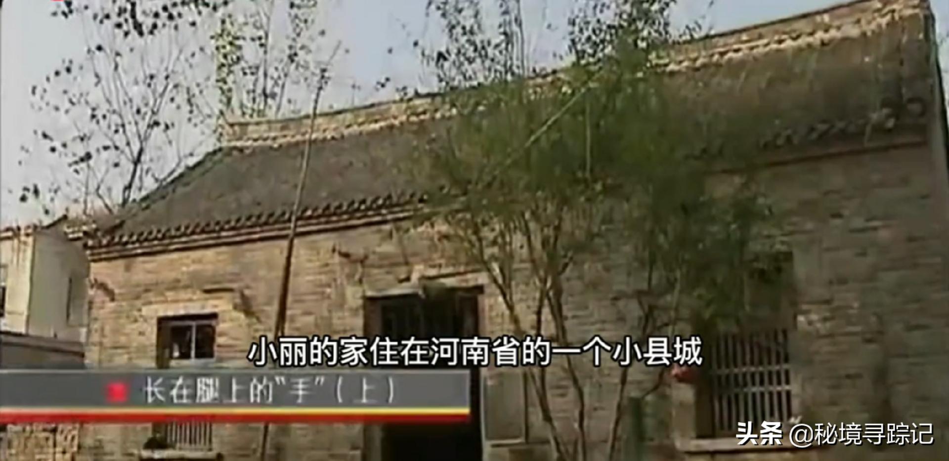 儿童胳膊断了做手术,小孩手臂断了真实手术