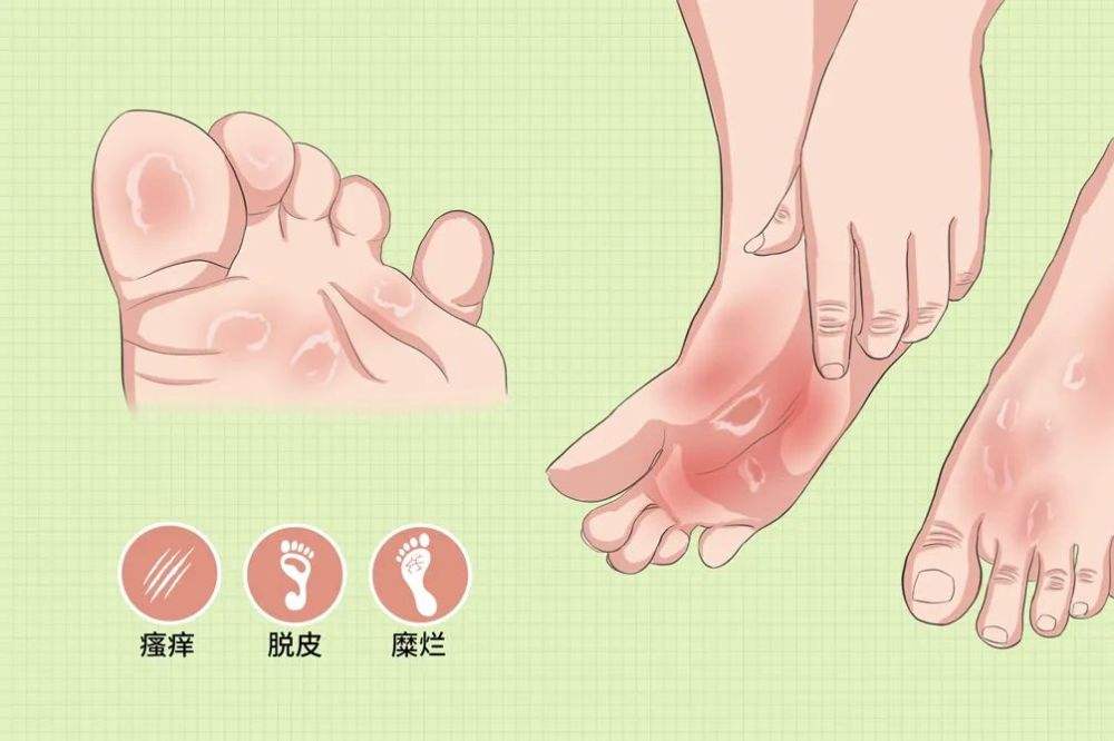 手足癣怎么治疗最有效,手足癣怎么治疗最快最有效