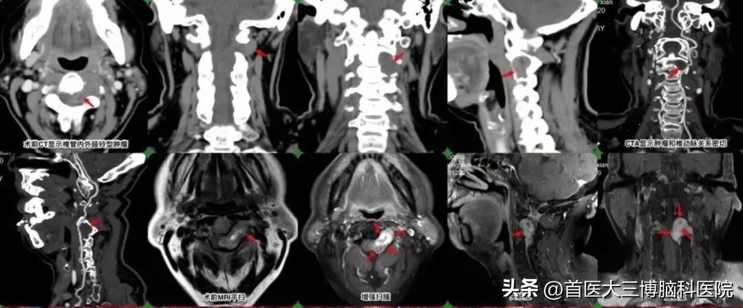 老人后颈部两根筋痛是什么原因,老人肩膀和脖子连接处疼痛