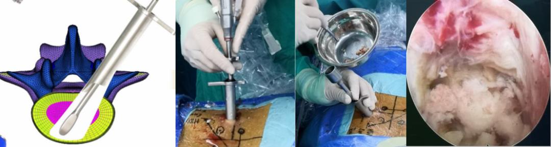 干货|一文掌握Endo-TLIF技术操作要点