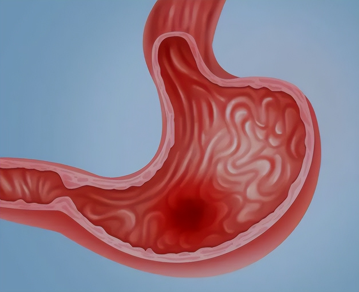 阿莫西林乱用会怎么样,阿莫西林别乱用6种病能用