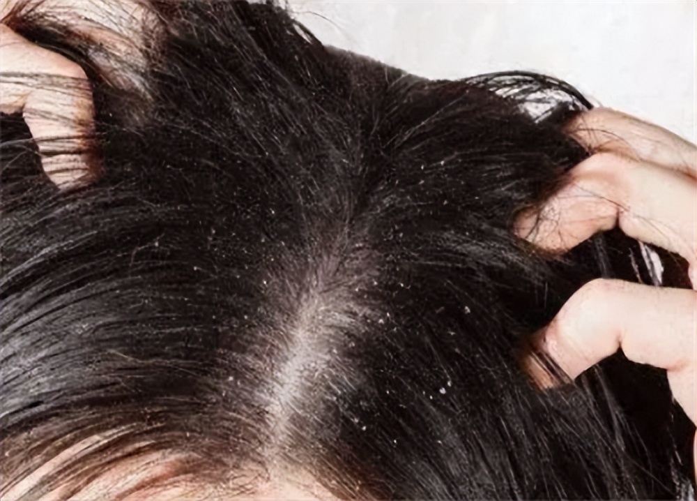 女子坚持半年用硫磺皂洗头怎么样,四川女生用硫磺皂洗头