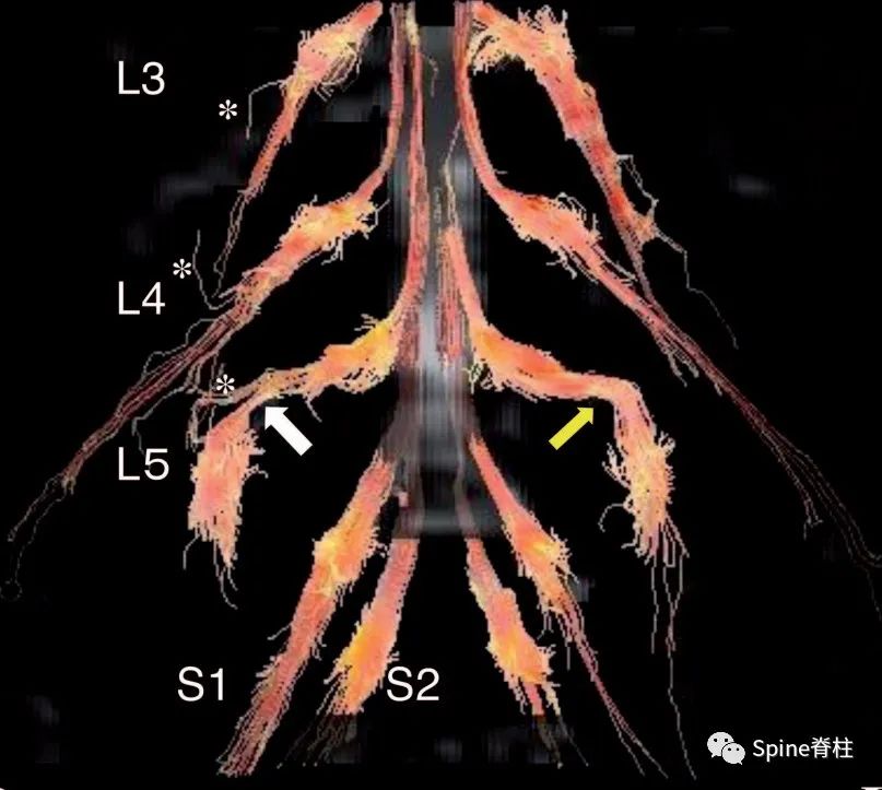 腰椎间盘突出症状表现,腰椎间盘突出症疼痛最佳止痛方法
