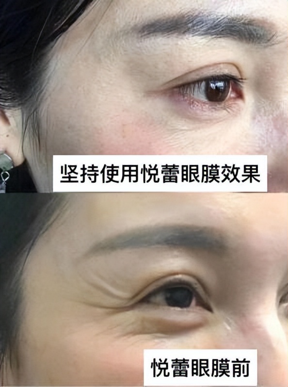 多肽抗皱能有效去眼部的皱纹吗,抗皱面膜可以淡化眼部皱纹吗