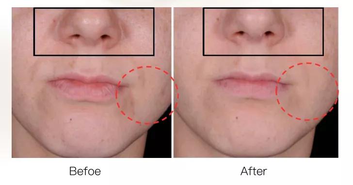 四效合一瘦身方案,四效合一全新升级