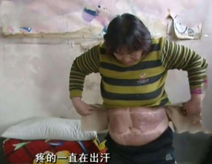 切肤之爱真实上演，河北妈妈割皮救子，就算割光全身的皮也不怕