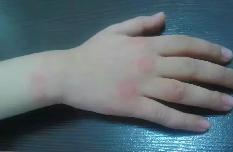 宝宝过敏起荨麻疹要不要挂急诊,宝宝得了荨麻疹需要忌口吗