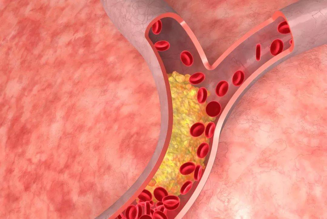 比阿托伐他汀好的药,比阿托伐他汀降脂效果好的药