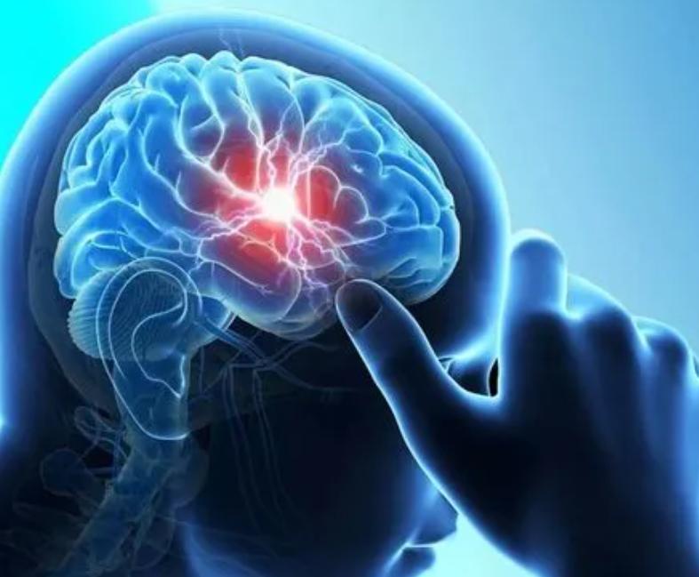 通过“脑之玄府”理论，来谈谈脑梗死的中医辨治思路