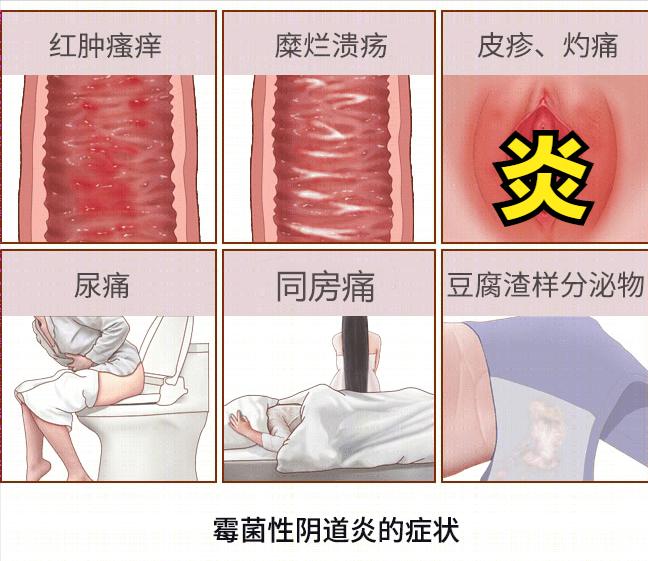 妇科炎症反反复复瘙痒怎么办,妇科分泌物黄色异味瘙痒