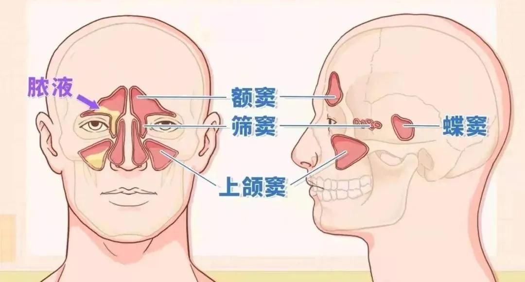 宝璋医院|感冒还是鼻窦炎？傻傻分不清楚？