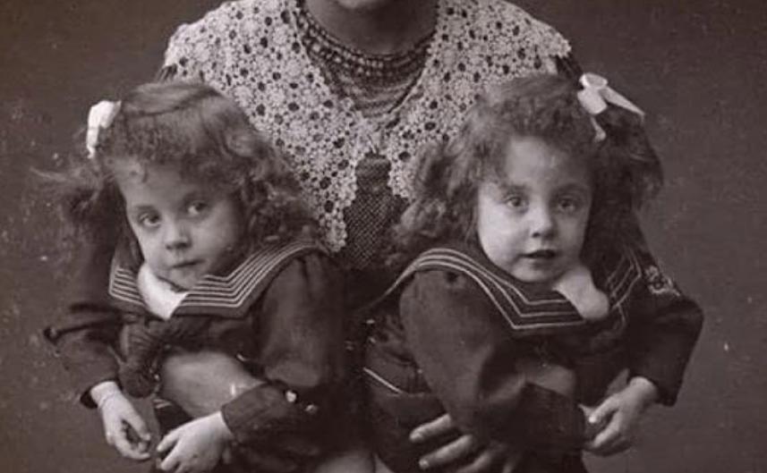 英国连体双胞胎姐妹,英国连体姐妹