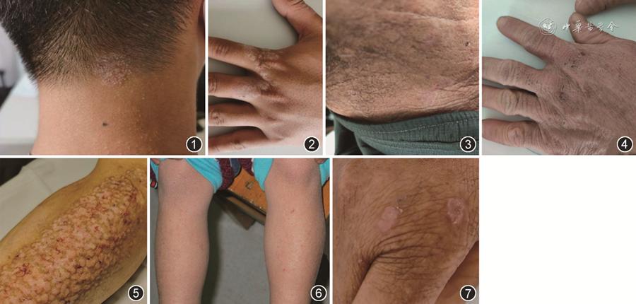 神经性皮炎发病率是多少,神经性皮炎的指南