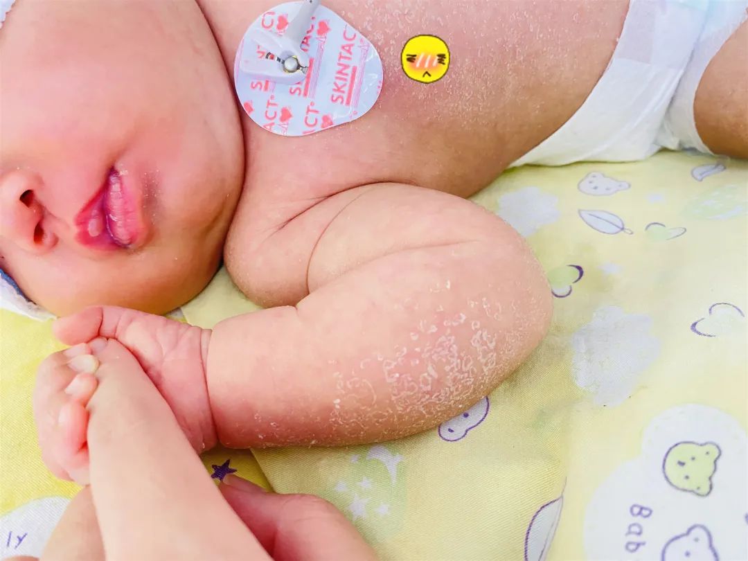 新生宝宝为啥会脱皮,身上脱皮是缺什么维生素