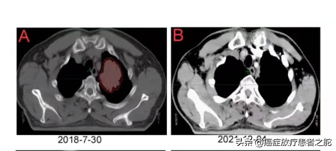 巨块型肝癌没有转移可以治愈吗,巨块型肝癌转移肺