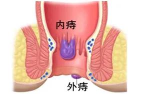 你有痔疮吗,女生患痔疮