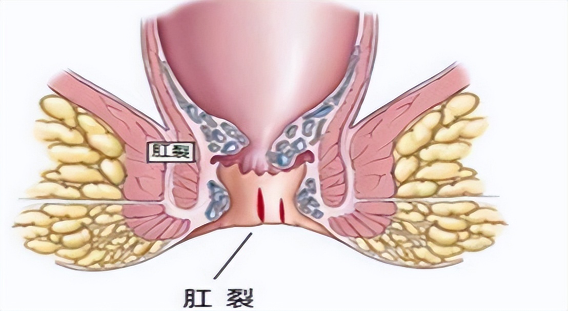 为什么会出现肛裂这样的情况,肛裂为什么女性居多