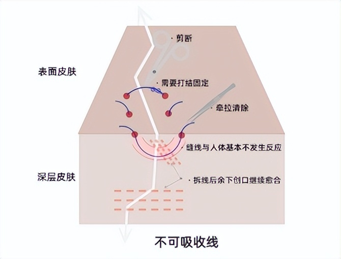 手术缝合线，伤口愈合就功成身退的无名英雄