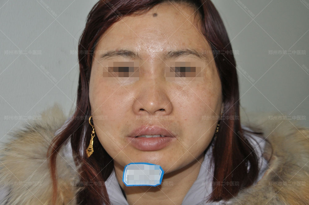 郑州市第二中医院治疗疤痕靠谱吗,郑州第二中医院治疤痕多少钱