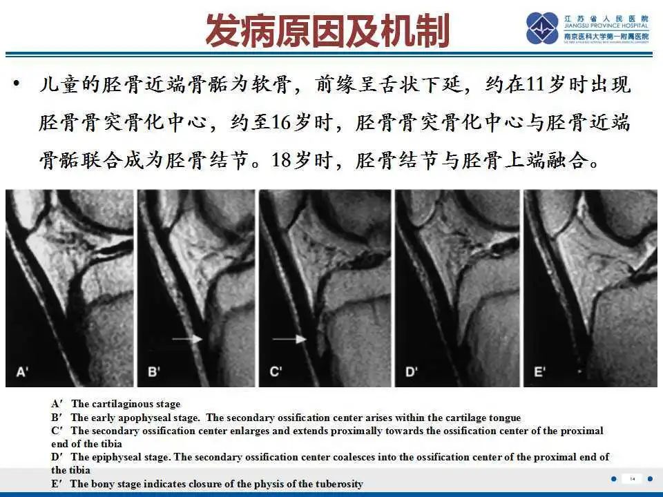 胫骨结节软骨炎要怎么治疗,胫骨结节骨软骨炎会癌变吗